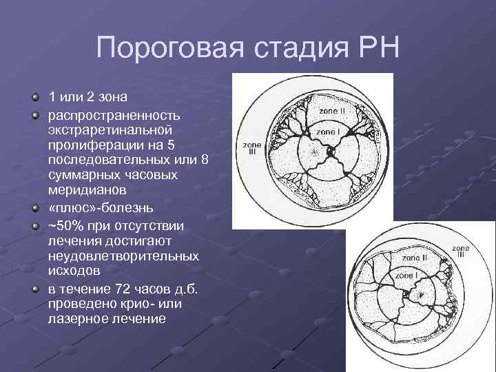 Пороговая стадия РН 1 или 2 зона распространенность экстраретинальной пролиферации на 5 последовательных или