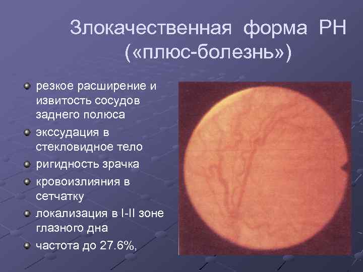 Злокачественная форма РН ( «плюс-болезнь» ) резкое расширение и извитость сосудов заднего полюса экссудация