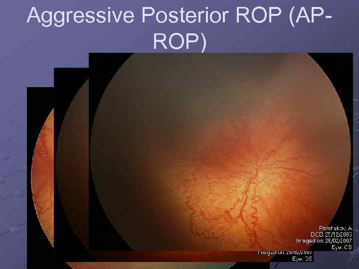 Aggressive Posterior ROP (APROP) 