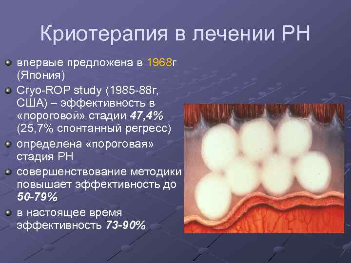 Криотерапия в лечении РН впервые предложена в 1968 г (Япония) Cryo-ROP study (1985 -88