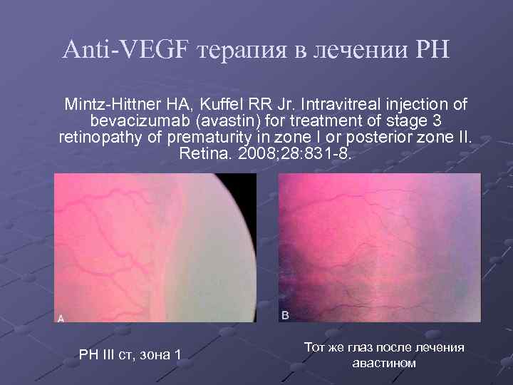 Anti-VEGF терапия в лечении РН Mintz-Hittner HA, Kuffel RR Jr. Intravitreal injection of bevacizumab