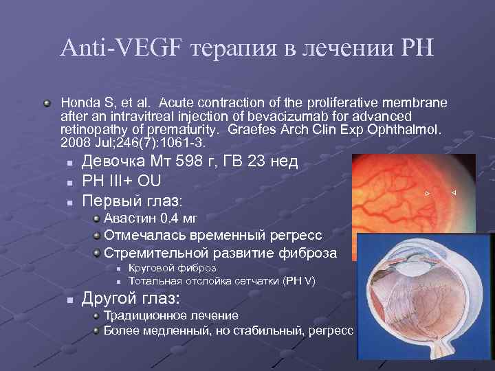 Anti-VEGF терапия в лечении РН Honda S, et al. Acute contraction of the proliferative