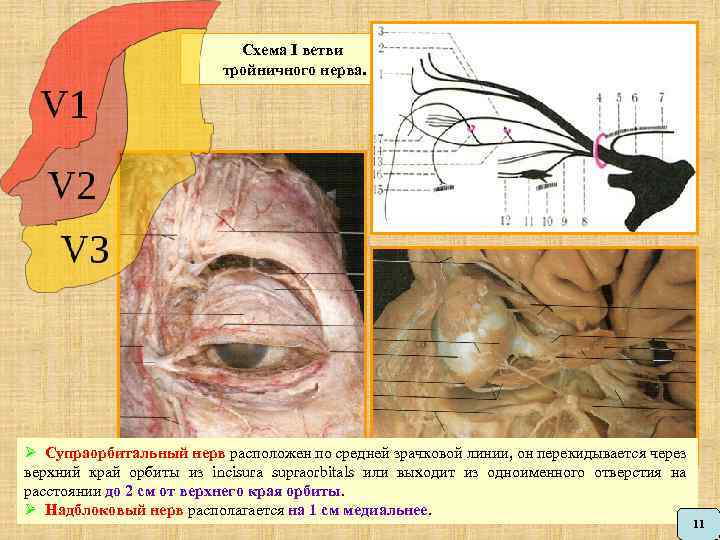 Схема I ветви тройничного нерва. Ø Супраорбитальный нерв расположен по средней зрачковой линии, он