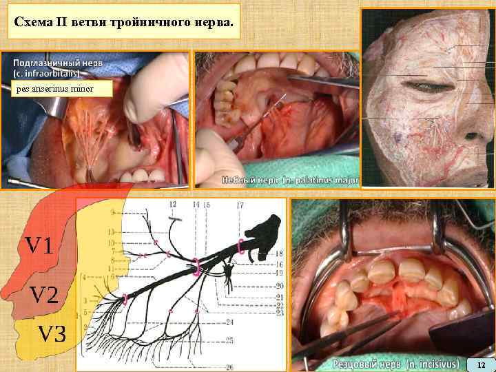 Схема II ветви тройничного нерва. pes anserinus minor 12 