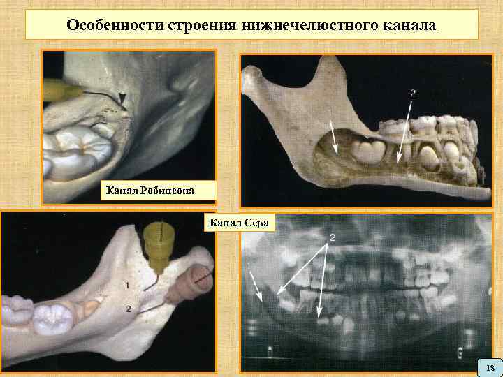 Особенности строения нижнечелюстного канала Канал Робинсона Канал Сера 18 