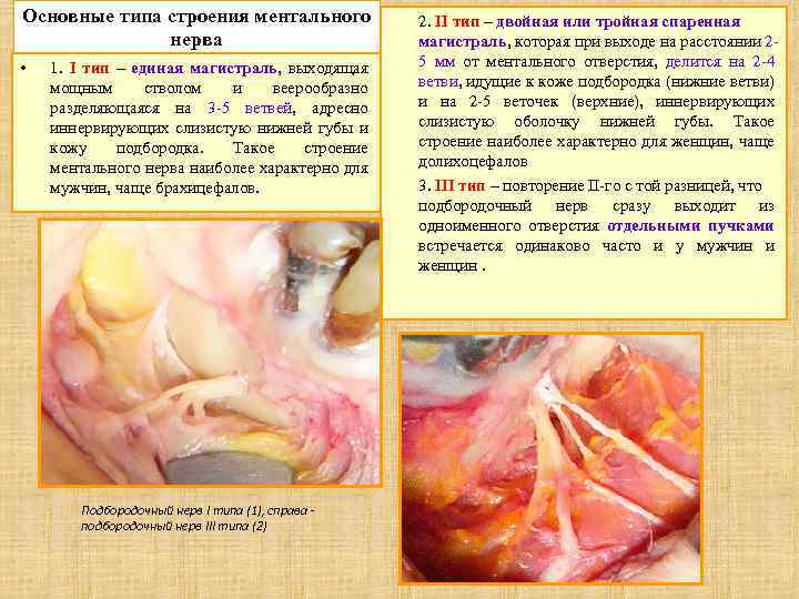 Основные типа строения ментального нерва • 1. I тип – единая магистраль, выходящая мощным