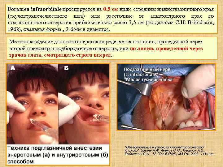 Foramen infraorbitale проецируется на 0, 5 см ниже середины нижнеглазничного края (скуловерхнечелюстного шва) или