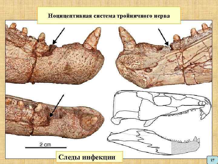 Ноцицептивная система тройничного нерва Следы инфекции 27 