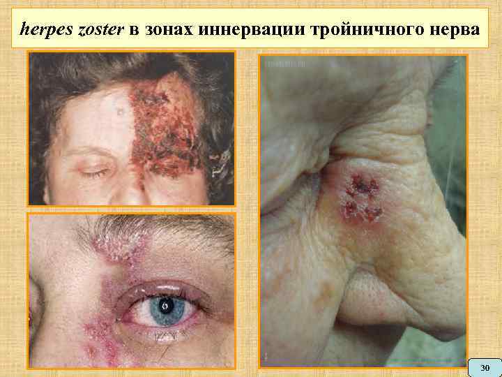 herpes zoster в зонах иннервации тройничного нерва 30 