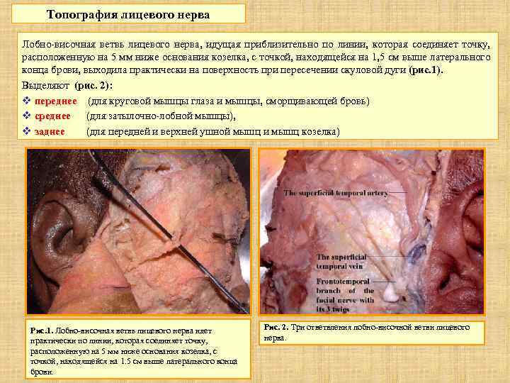 Топография лицевого нерва Лобно-височная ветвь лицевого нерва, идущая приблизительно по линии, которая соединяет точку,