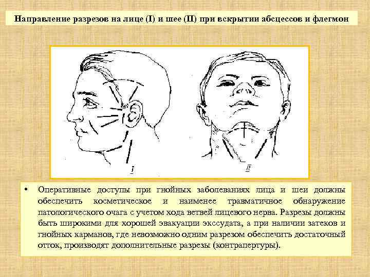 Направление разрезов на лице (I) и шее (II) при вскрытии абсцессов и флегмон •