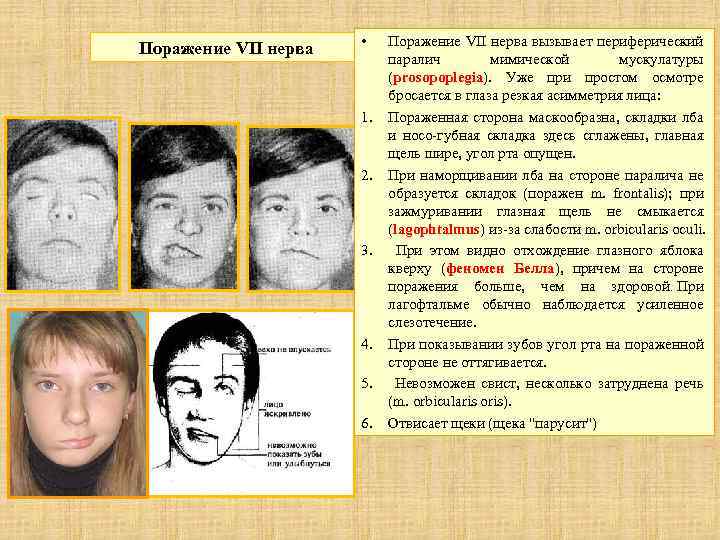 Поражение VII нерва • 1. 2. 3. 4. 5. 6. Поражение VII нерва вызывает