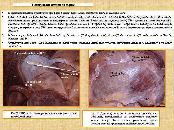 Топография лицевого нерва • • В височной области существует три фасциальных слоя. К ним
