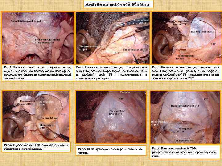 Анатомия височной области Рис. 1. Лобно-височная ветвь лицевого нерва, идущая в свободном бессосудистом ареолярном