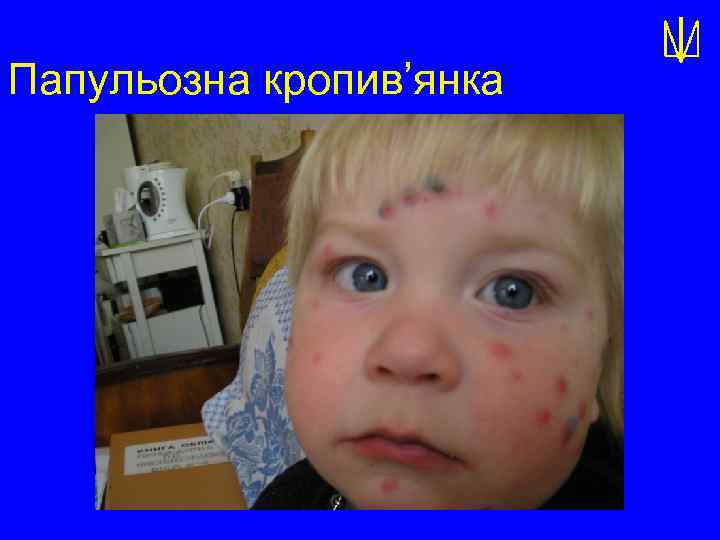 Папульозна кропив’янка 