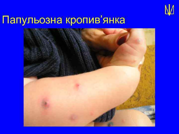 Папульозна кропив’янка 