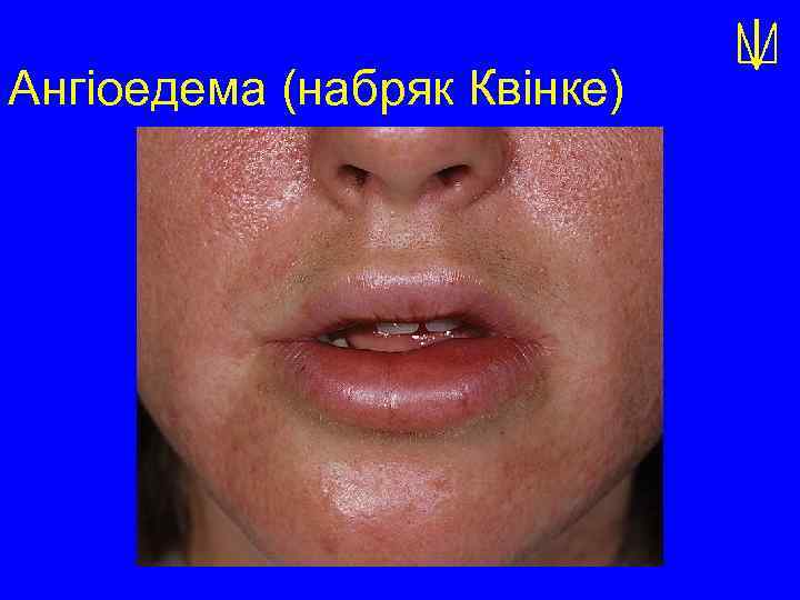 Ангіоедема (набряк Квінке) 