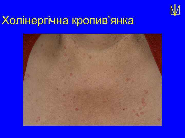 Холінергічна кропив’янка 