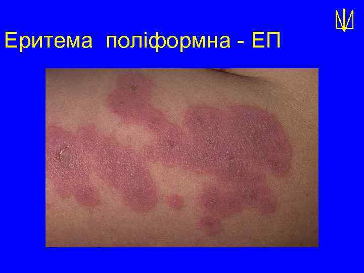 Еритема поліформна - ЕП 