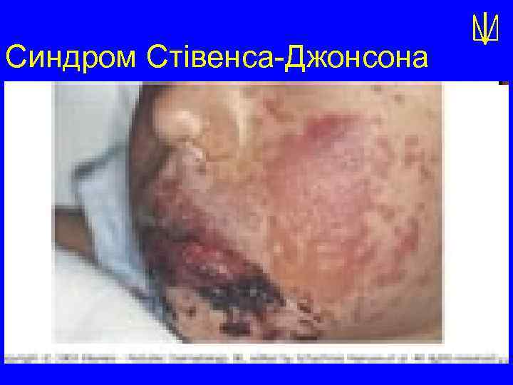 Синдром Стівенса-Джонсона 