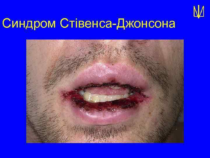 Синдром Стівенса-Джонсона 