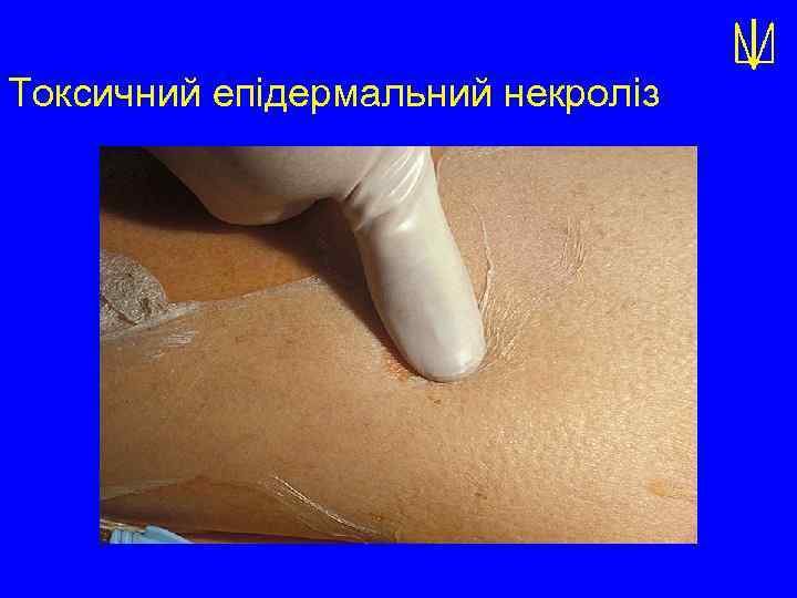 Токсичний епідермальний некроліз 