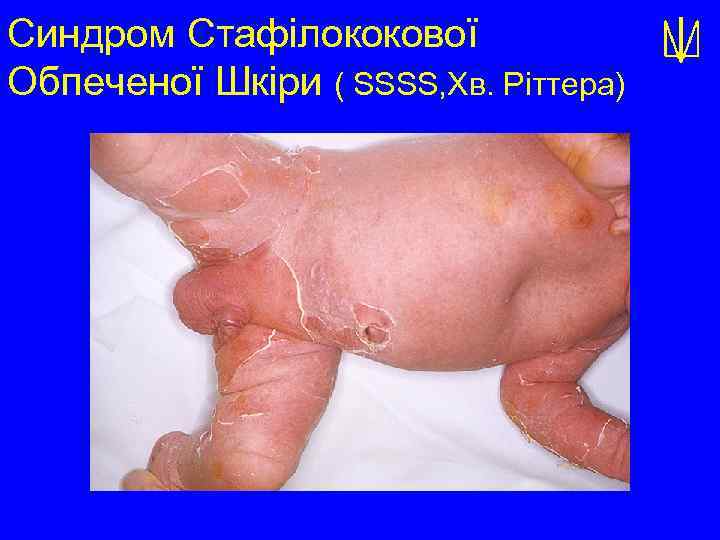 Синдром Стафілококової Обпеченої Шкіри ( SSSS, Хв. Ріттера) 