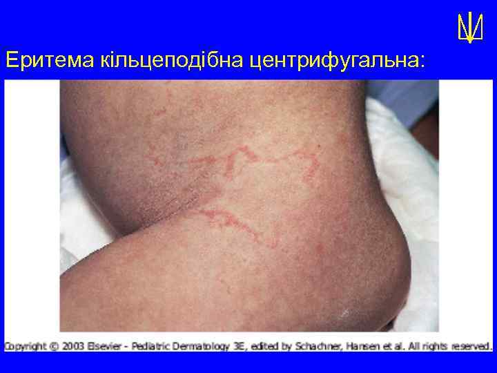Еритема кільцеподібна центрифугальна: 