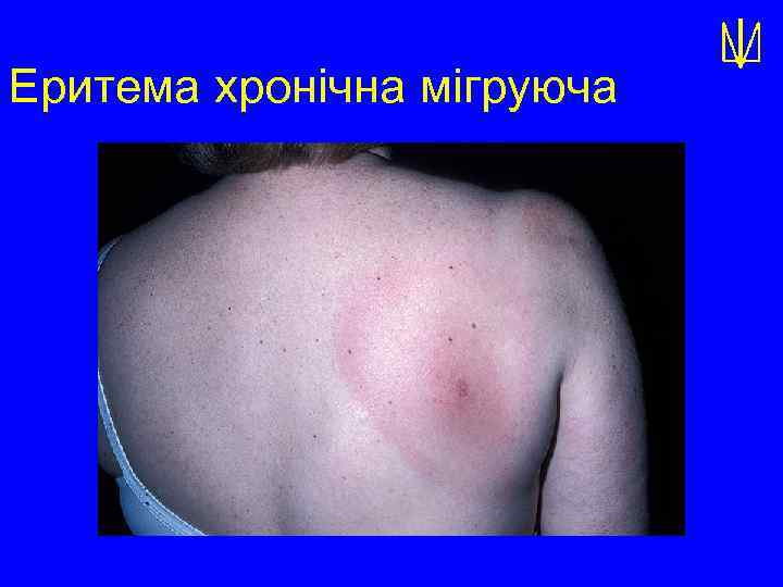 Еритема хронічна мігруюча 