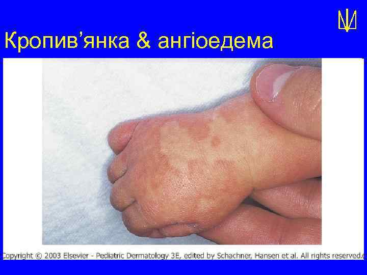 Кропив’янка & ангіоедема 