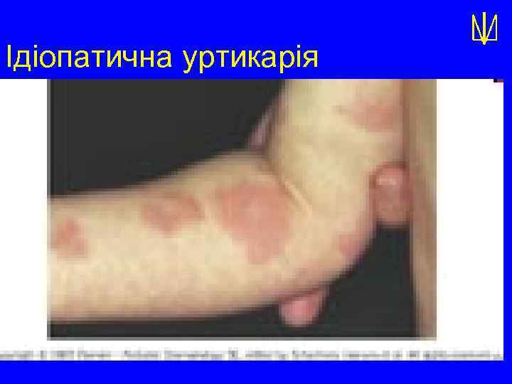 Ідіопатична уртикарія 