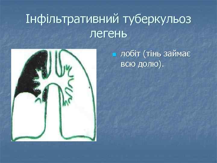 Інфільтративний туберкульоз легень n лобіт (тінь займає всю долю). 