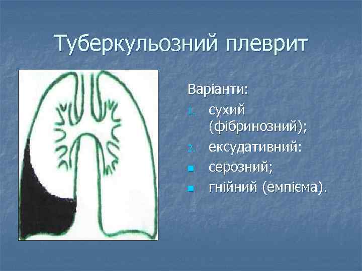 Туберкульозний плеврит Варіанти: 1. сухий (фібринозний); 2. ексудативний: n серозний; n гнійний (емпієма). 