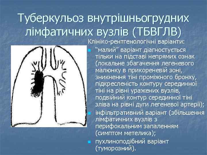 Туберкульоз внутрішньогрудних лімфатичних вузлів (ТБВГЛВ) Клініко-рентгенологічні варіанти: n “малий” варіант діагностується тільки на підставі