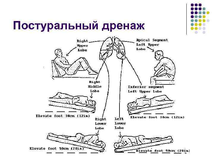 План ухода за пациентом при пневмонии