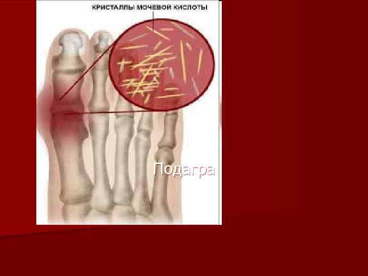 Подагра 
