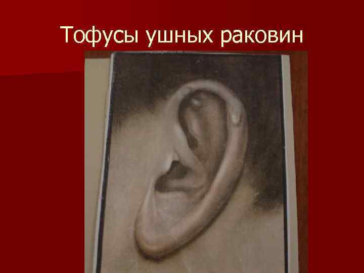 Тофусы ушных раковин 