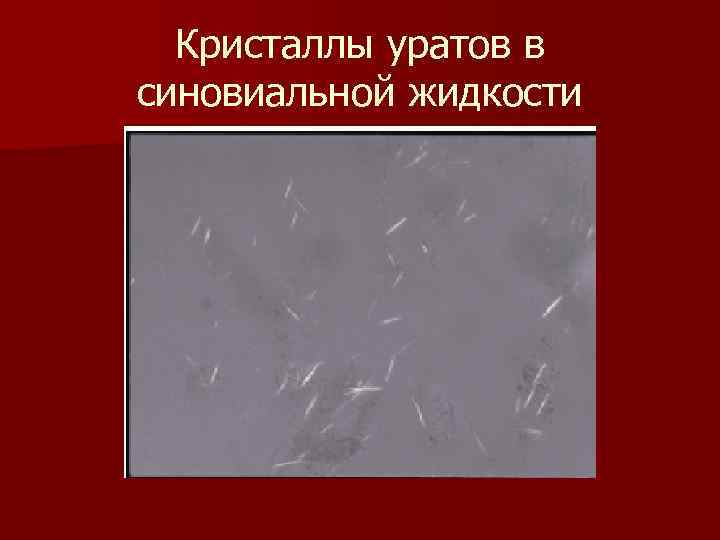 Кристаллы уратов в синовиальной жидкости 