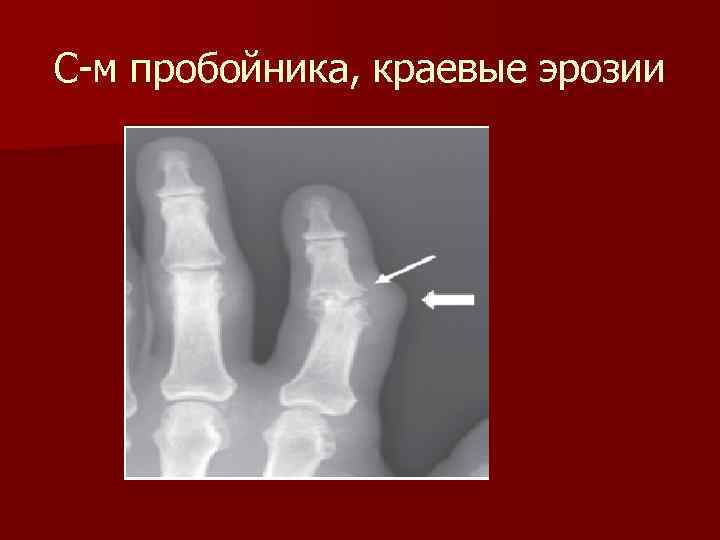 С-м пробойника, краевые эрозии 