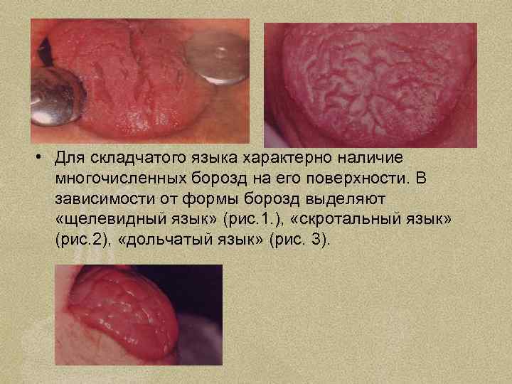  • Для складчатого языка характерно наличие многочисленных борозд на его поверхности. В зависимости