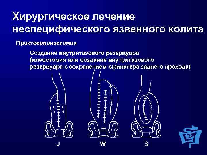 Схема лечения язвенного колита