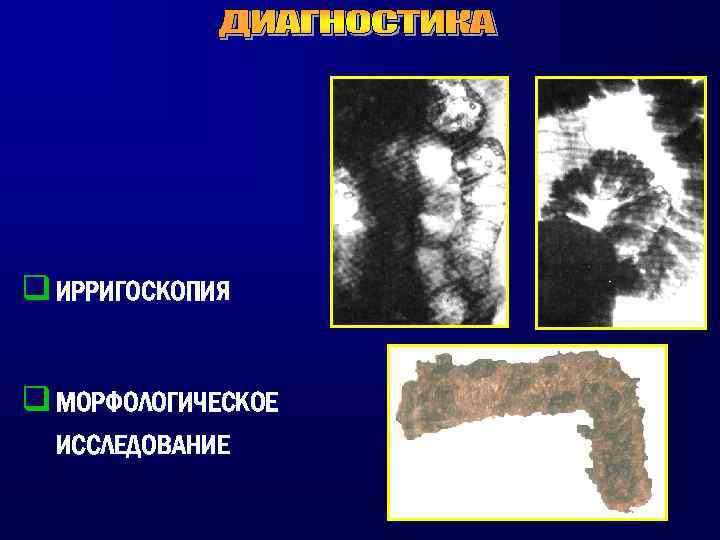 4 ирригоскопия. Ирригоскопия картинки.