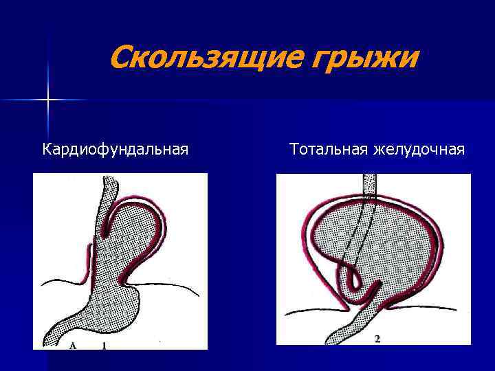 Скользящая грыжа. Кардиофундальная грыжа. Кардиофундальная кардиофундальная грыжа. Кардиофундальная желудочная грыжа под.