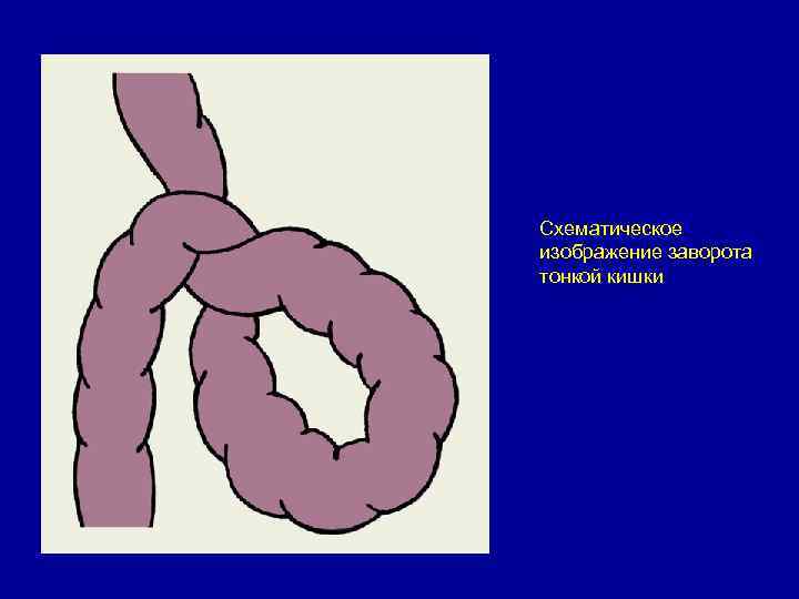 Схематическое изображение заворота тонкой кишки 