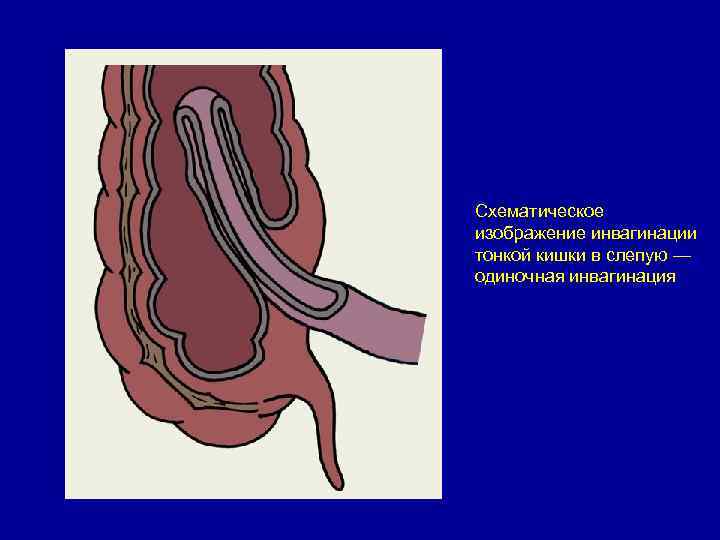 Схематическое изображение инвагинации тонкой кишки в слепую — одиночная инвагинация 