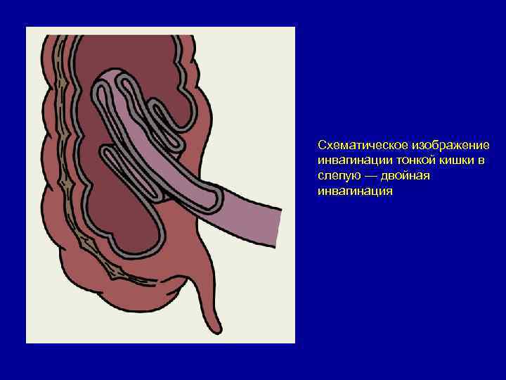 Схематическое изображение инвагинации тонкой кишки в слепую — двойная инвагинация 