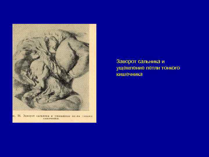 Заворот сальника и ущемление петли тонкого кишечника 