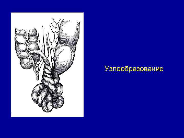 Узлообразование 