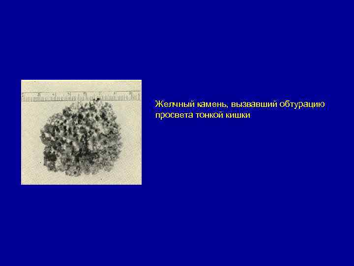 Желчный камень, вызвавший обтурацию просвета тонкой кишки 