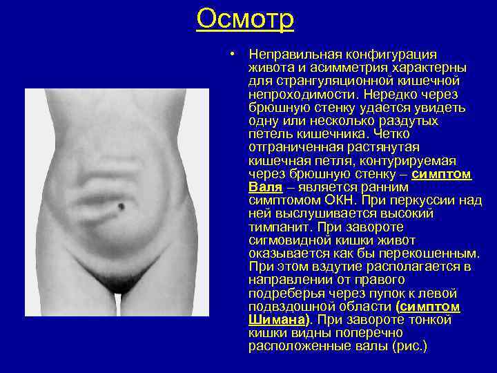 Осмотр • Неправильная конфигурация живота и асимметрия характерны для странгуляционной кишечной непроходимости. Нередко через